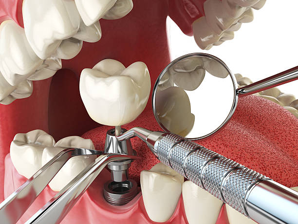 Best Emergency Root Canal Treatment in Glen Head, NY
